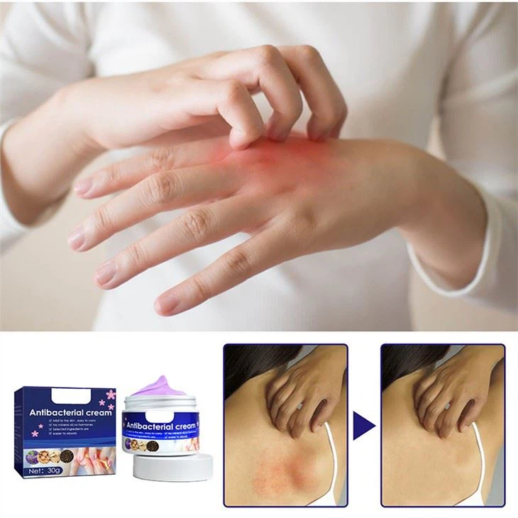 Skin Itching Cream